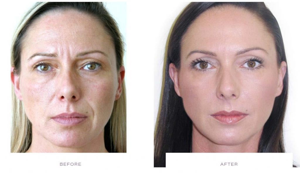 Botox Muscle Relaxing Before After