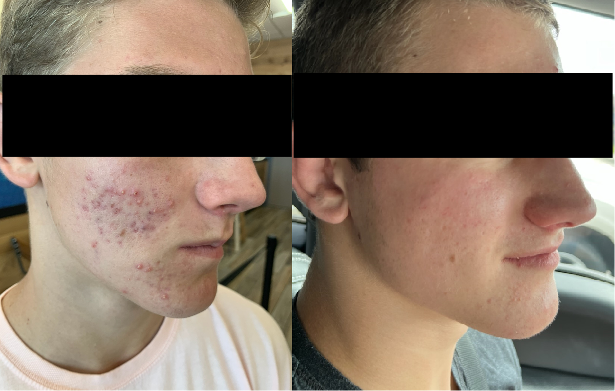 Morpeus - Acne - Before & After
